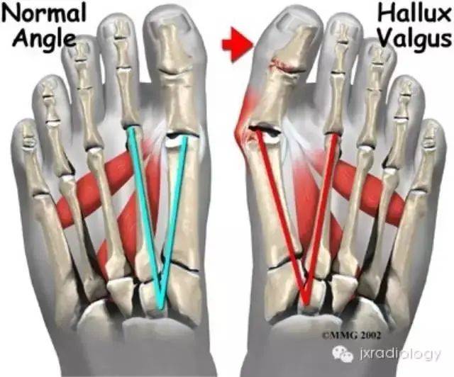 踇外翻畸形（Hallus valgus）