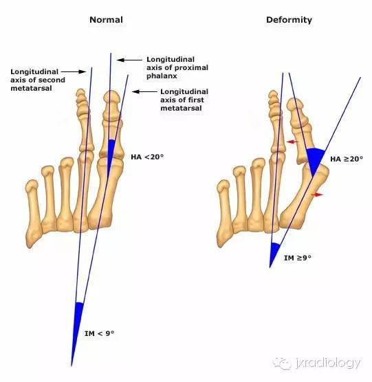 踇外翻畸形（Hallus valgus）
