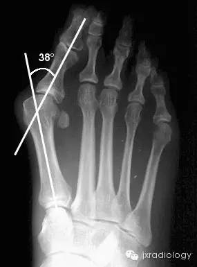 踇外翻畸形（Hallus valgus）