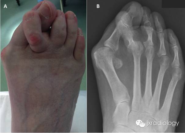 踇外翻畸形（Hallus valgus）
