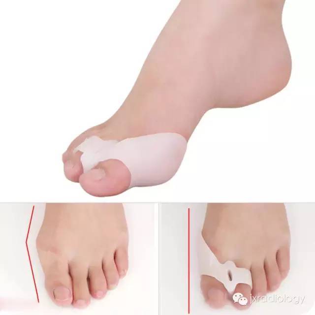 踇外翻畸形（Hallus valgus）