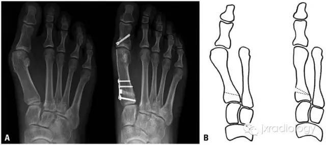踇外翻畸形（Hallus valgus）