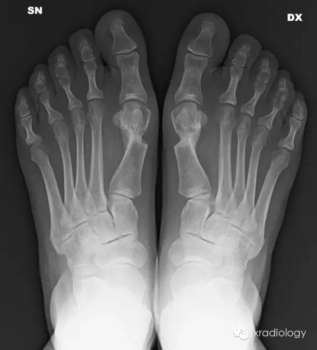 踇外翻畸形（Hallus valgus）