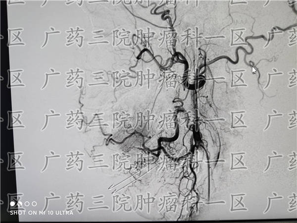 放疗一次多少钱<strong></p>
<p>黄金一钱多少钱</strong>？放疗需要多少钱可以完成