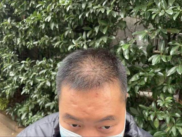 “还能反光<strong></p>
<p>好的理财</strong>！”长沙男子植发近9月称后脑勺“像狗啃过”