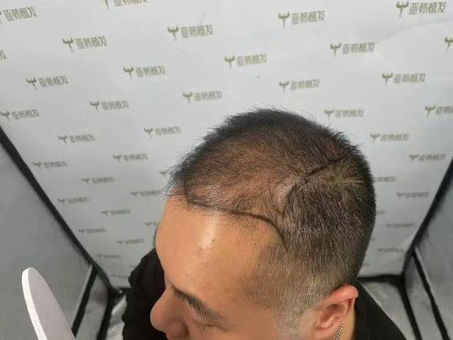 “还能反光<strong></p>
<p>好的理财</strong>！”长沙男子植发近9月称后脑勺“像狗啃过”