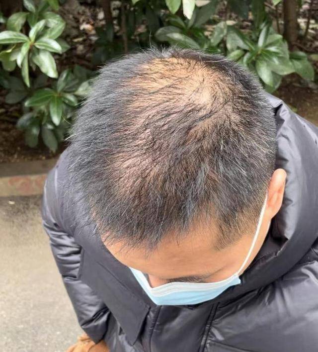 “还能反光<strong></p>
<p>好的理财</strong>！”长沙男子植发近9月称后脑勺“像狗啃过”