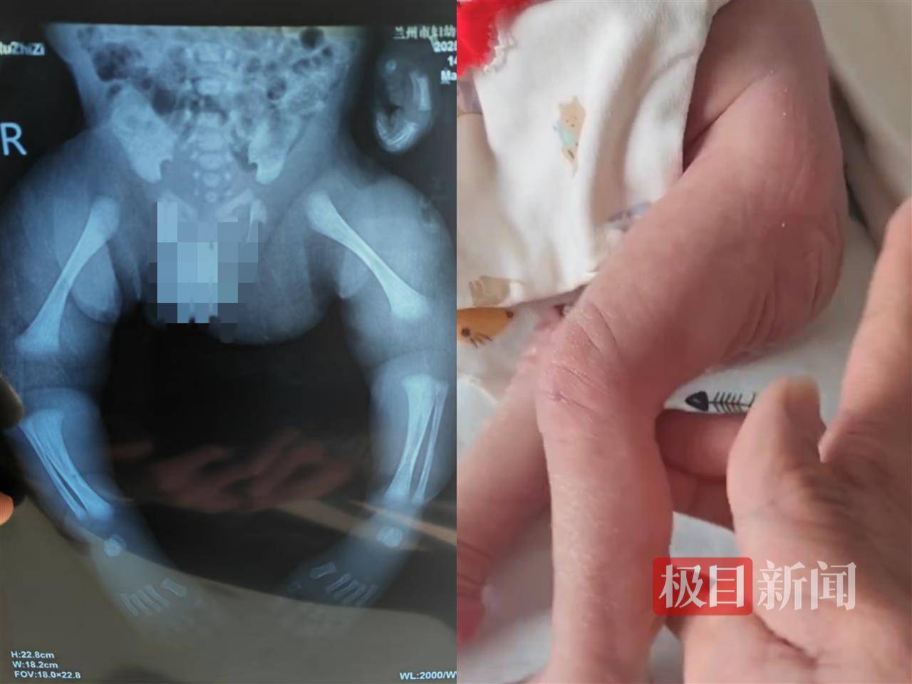 二胎出生查出先天性病症或落下残疾<strong></p>
<p>广发理财</strong>，残疾父母称医院产检漏检、未尽告知义务，医院及医调委回应