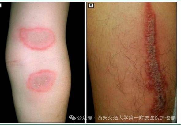 西安多区发现隐翅虫？千万别拍<strong></p>
<p>稳理财</strong>！毒液堪比硫酸