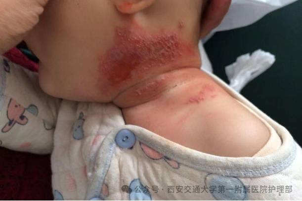 西安多区发现隐翅虫？千万别拍<strong></p>
<p>稳理财</strong>！毒液堪比硫酸