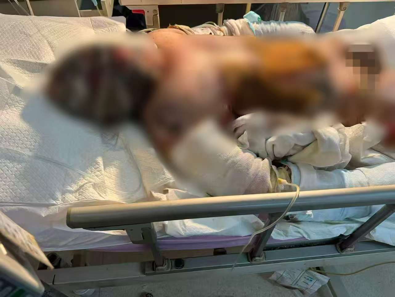 父子在哈尔滨一亲戚公司上班遇爆炸全身烧伤<strong></p>
<p>理财教程</strong>,治疗花费近百万公司拒赔偿?亲戚回应