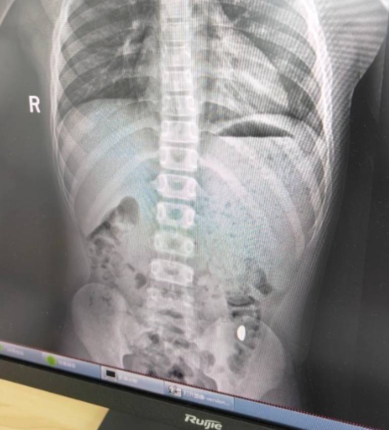 “熊孩子”误吞10克重金豆<strong></p>
<p>商业银行理财</strong>,妈妈:天天叮嘱他不要在外面拉屎