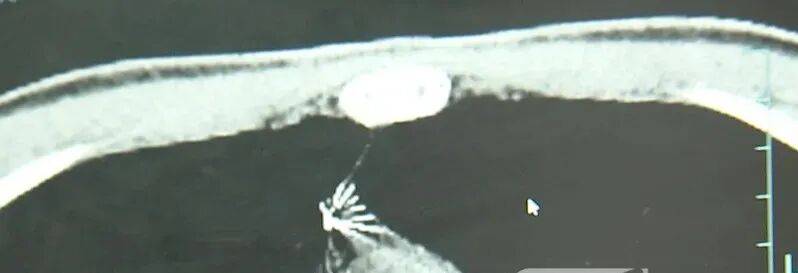 17岁小伙参军体检发现胸腔内有根5cm缝衣针<strong></p>
<p>理财书籍推荐</strong>,父母回忆或是1岁时扎入,取出时已锈迹斑斑