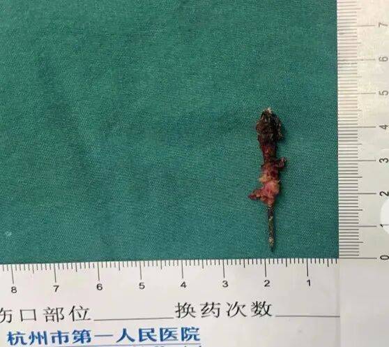 17岁小伙参军体检发现胸腔内有根5cm缝衣针<strong></p>
<p>理财书籍推荐</strong>,父母回忆或是1岁时扎入,取出时已锈迹斑斑